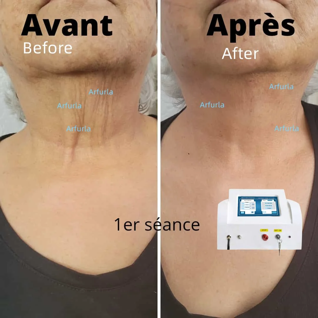 2024 Sma905 200um 300um، 400um، 600um، 800um الألياف الضوئية العارية على الرقبة Jowls إندو ألياف شد الوجه القابل للتصرف