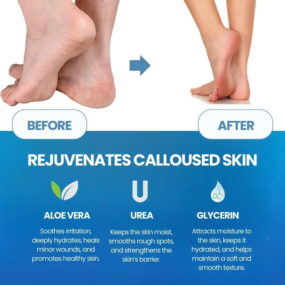 Foot Cuticle Remove Dead Foot Exfoliator Softener Remove Dead Skin Calluses Foot Mask Pedicure Nail Enhancer Removed Dead Skin view 4