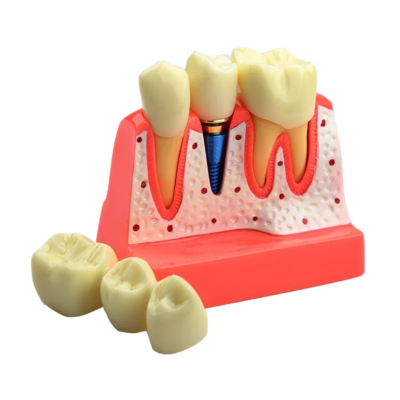 2Pcs Dental Model Dental Implant Model Denture Bridge Crown Porcelain Restoration Model Dentist Teaching Demonstration Models