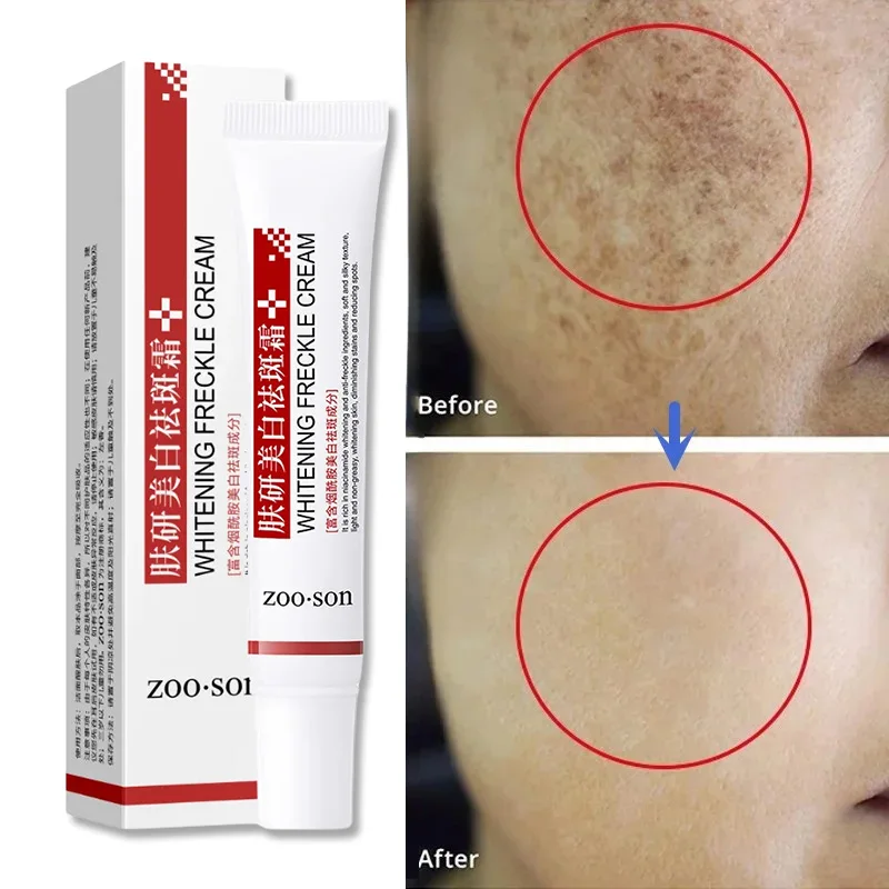 Eficaz Whitening Freckle Cream, Niacinamida, Remova manchas escuras, Anti Freckle, Fade Pigmentation, Cremes de melasma, Skin Care