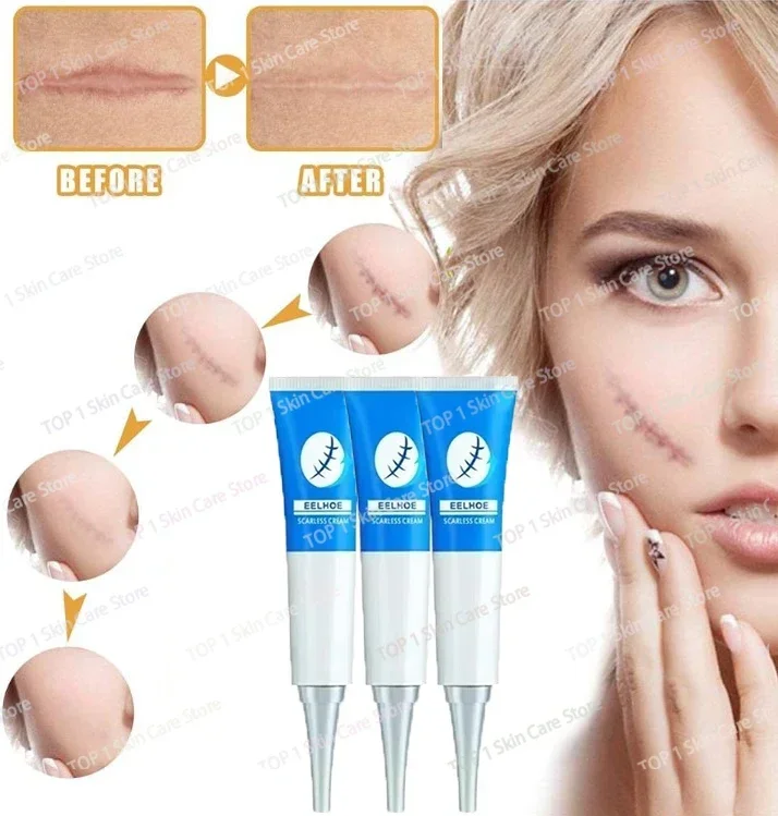 

Acne Scar Removal Repair Burn Surgical Scars Stretch Marks Promote Cell Regeneration Repair Treatment Body Skin Care09