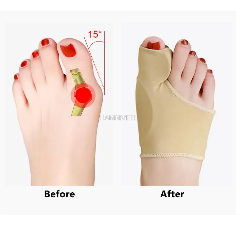 2Pcs Toe Separator Hallux Valgus Corrector Ballen Haluksy Vorfuß Pad Finger Separator Haarglätter Für Toe Bunion Corrector