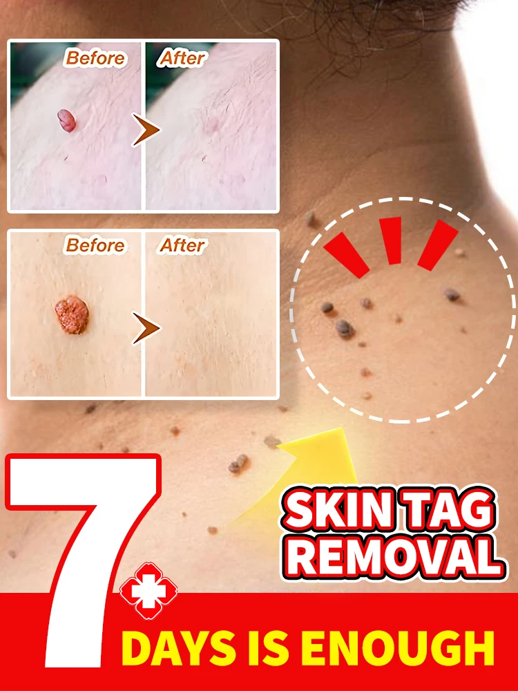 

Automatic Micro Skin Tag Remover Standard and Micro Skin Tag Removal Kit Remover Facial Care Beauty Tool