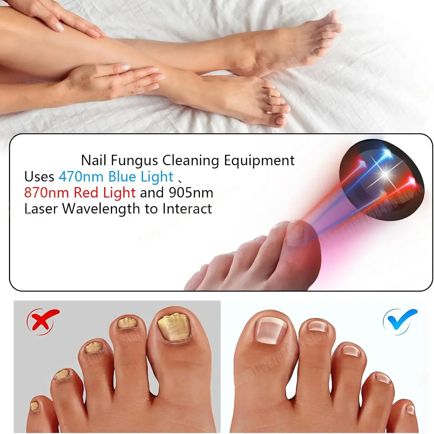 爪真菌レーザーペン 爪真菌クリーニングレーザー装置 爪真菌レーザー治療 損傷した変色した厚い足の爪