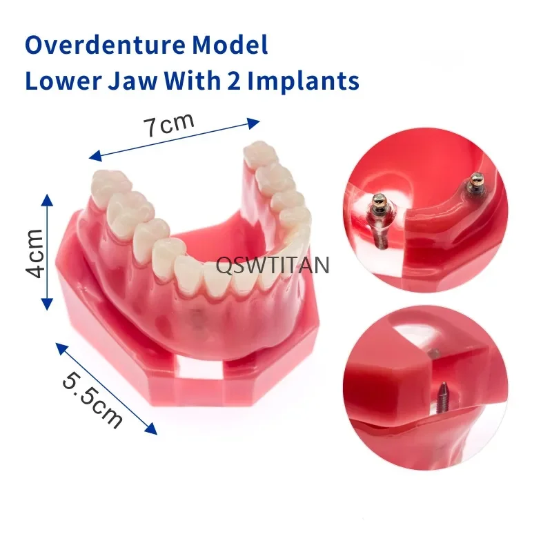 치과 임플란트 복원 치아 모델, 이동식 브리지 틀니, 교육 연구 모델