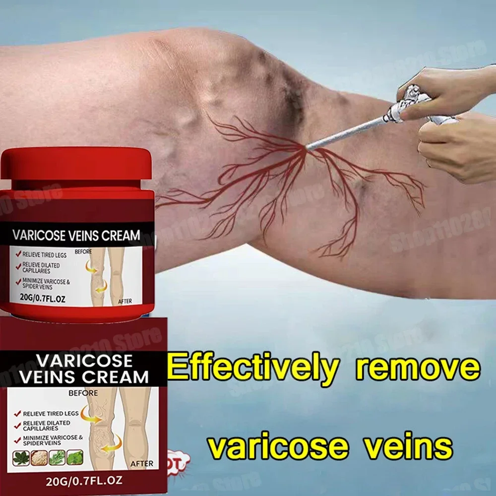 Original variceal removal cream effectively treats spider vein pain and heals it, spider vein removal