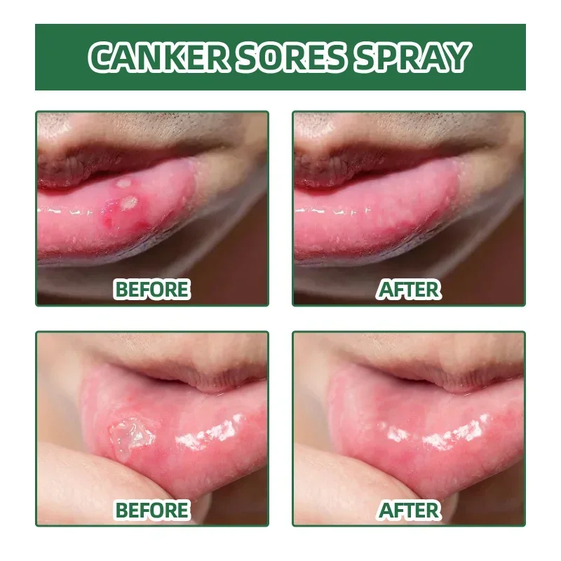 Mouth ulcer spray Treatment swollen gums oral Canker Sores Pain Relief fresh breath Antibacteria Halitosis mouth Clean care