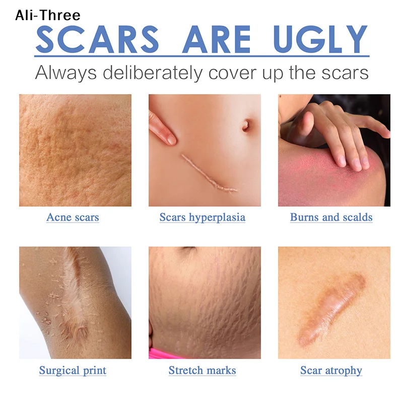 

Silicone Scar Sheets Clear Scars Tape Strip Invisible Silicone Self-Adhesive Patches For C-Section Surgery Keloid Burn Acne