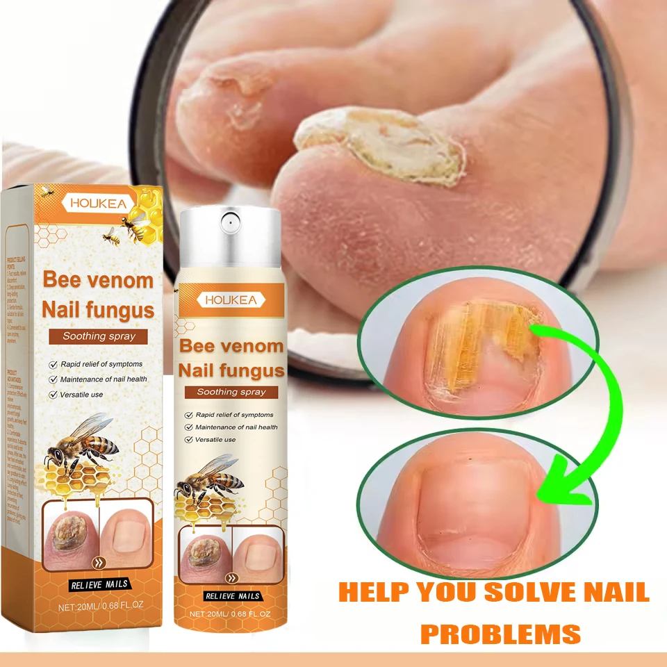 

Fungal Nail Treatment Serum Spray Foot Nail Fungus Removal Repair Gel Anti Infection Paronychia Onychomycosis Foot Nails Care