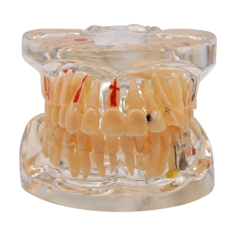 Dental Model Teeth Neural Repair Dental Implant Pathological Model Medical Teaching Study Tools New Dentist Demonstration Model