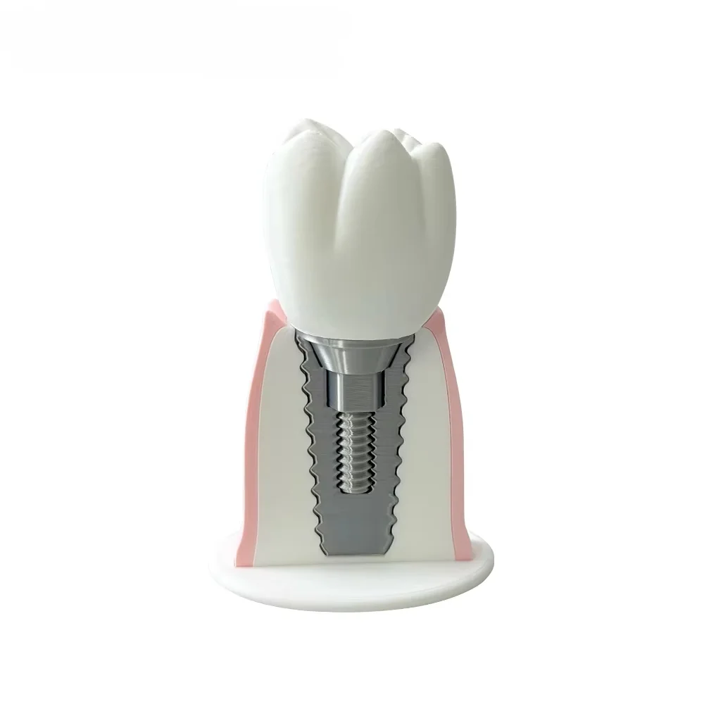 Detachable Dental Implant Model Dentistry Teaching Training Demonstration Display Model Dentist Patient Communication Model