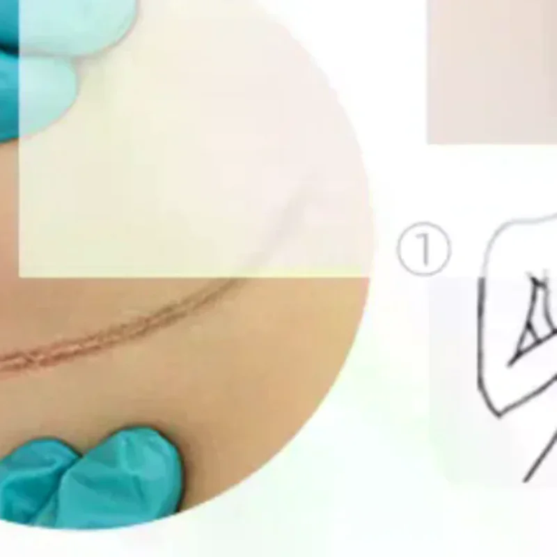Reusable Silicon Gel Invisible Stickers Circular Arc Chest Invisible Concealer Scar Repair Patch Tattoo Flaw Conceal Tape