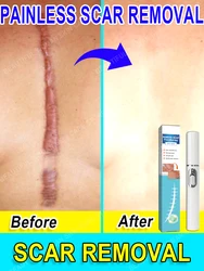 ACNE SCARS,SURGICAL PRINT,SCARS HYPERPLASIA,STRETCH MARKS,BURNS AND SCALDS,SCAR ATROPHY