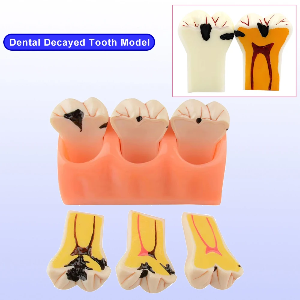 

Denture Caries Disease Tooth Model Decomposition Decay Tooth Model Dental Teaching Tools