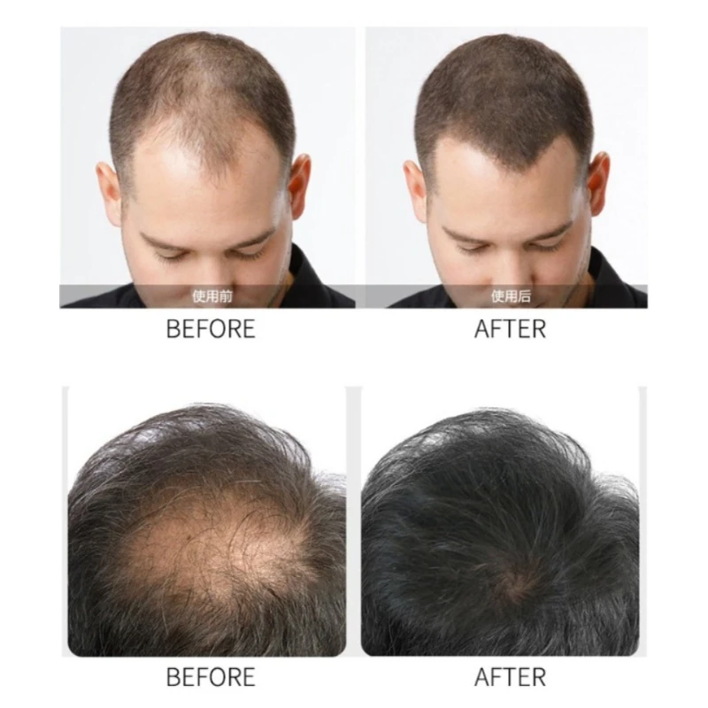BUNEE Hair Loss Concealer 27.5g Set Hair Building Fibers Instant Thickening Powder for Thin Hair with Comb