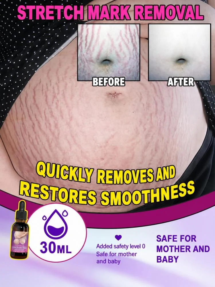 Stretch Mark Essential Oil: Enhances elasticity and fades stretch marks (including those caused by weight gain), while providing skin-softening, nourishing, moisturizing, and firming benefits.
