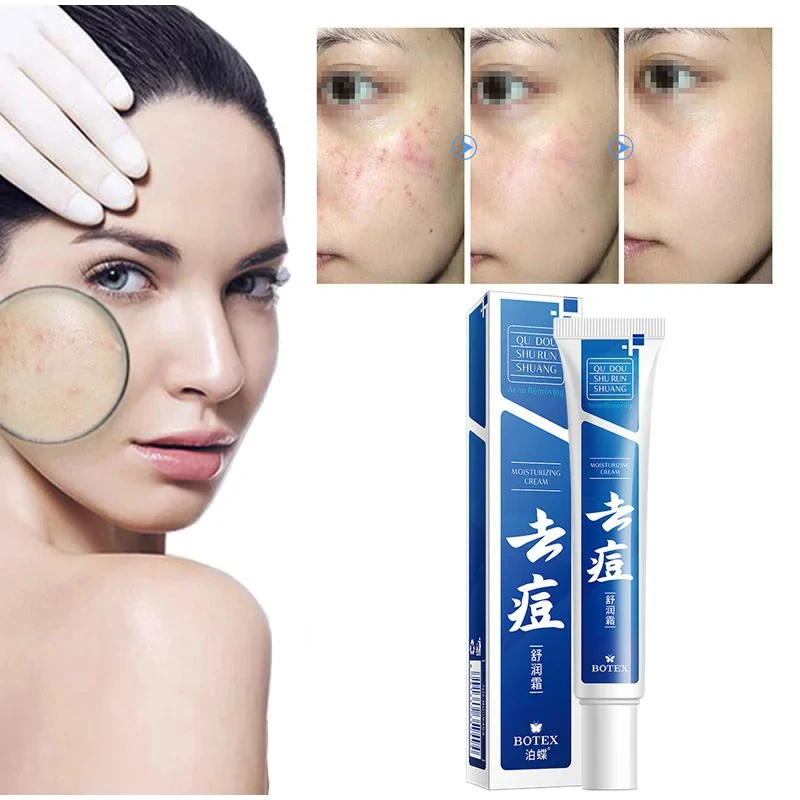 Acne Cream Anti-acne Oil Control Repair Fade Acne Spots Shrink Pores Whitening Moisturizing Face Smooth Gel Skin Cream Supplies