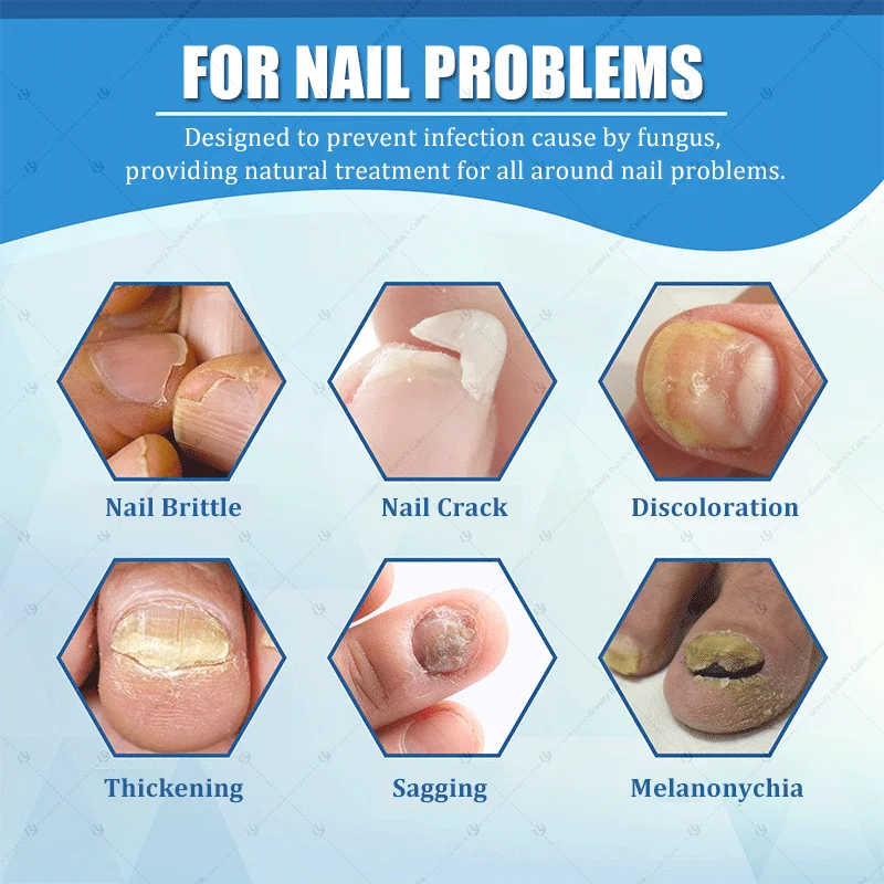 เล็บเลเซอร์สีน้ำเงิน