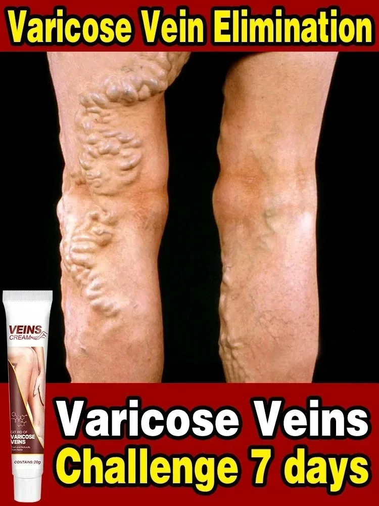 Varicose Vein Relief Paste Improve Blood Circulations Spider Varicose Vein For Tired Heavy Legs Fast Relief New