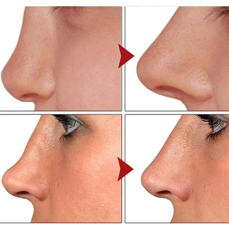 Nose Lift Up Heighten Essence Essential Oil Nose Up Heighten Rhinoplasty Nasal Bone Remodeling Pure Natural Care Thin Nose Serum