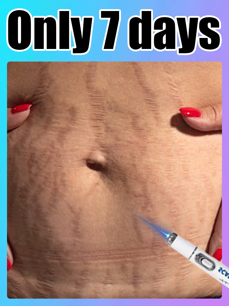 妊娠線の永久除去レーザー製品