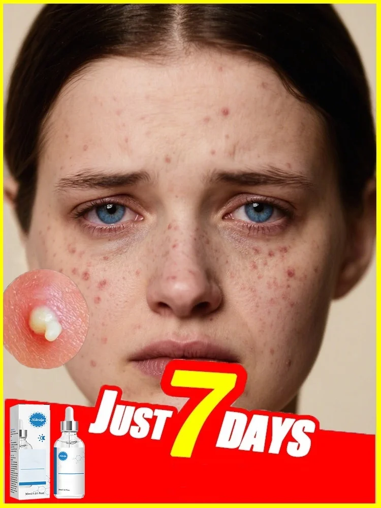 

Herbal Acne Marks Mouisture Clean Smooth Skin