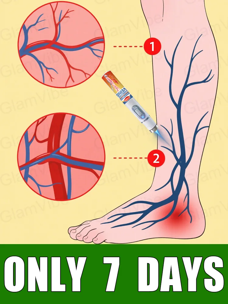 

blue light pen solve varicose veins, hot sale leg care tools