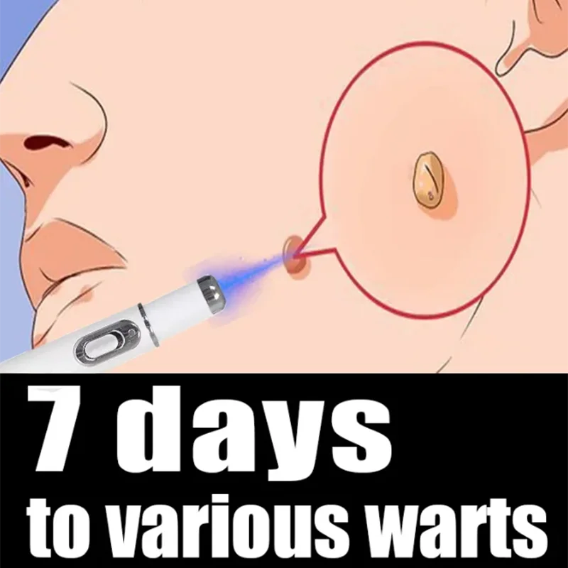 Blue Light Pen Maximum Strength Common and Plantar Wart Falling off warts care tool