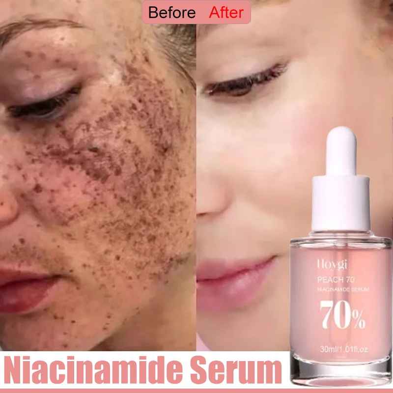 

Niacinamide Freckle Removal Whitening Essence Fade Dark Spots Melasma Treatment Brighten Improve Dull Serum Korean Cosmetics