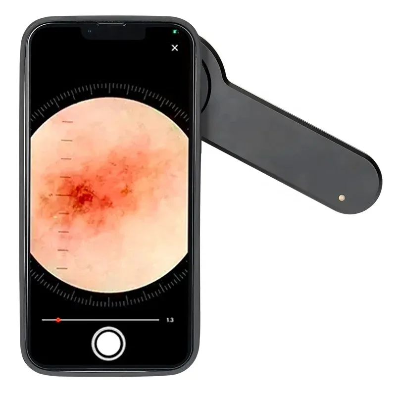 IBOOLO DE-3100 Handheld Dermatoscope Dermoscopy Of Melanoma And Non-melanoma Skin Cancers