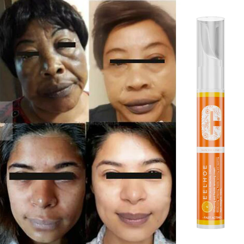 15ml verdünntes Melanin vc Aufhellung spunkt entfernen Creme entfernen Flecken aufhellen Hautton Bleaching Haut Gesichts pflege Peelings