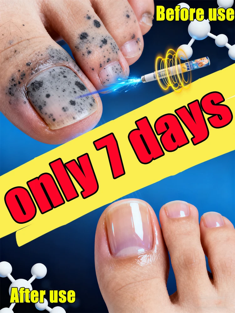 

Скажи прощай, чтобы гвоздь грибка за 7-днем. Безопасный и быстрый, без вторсырья