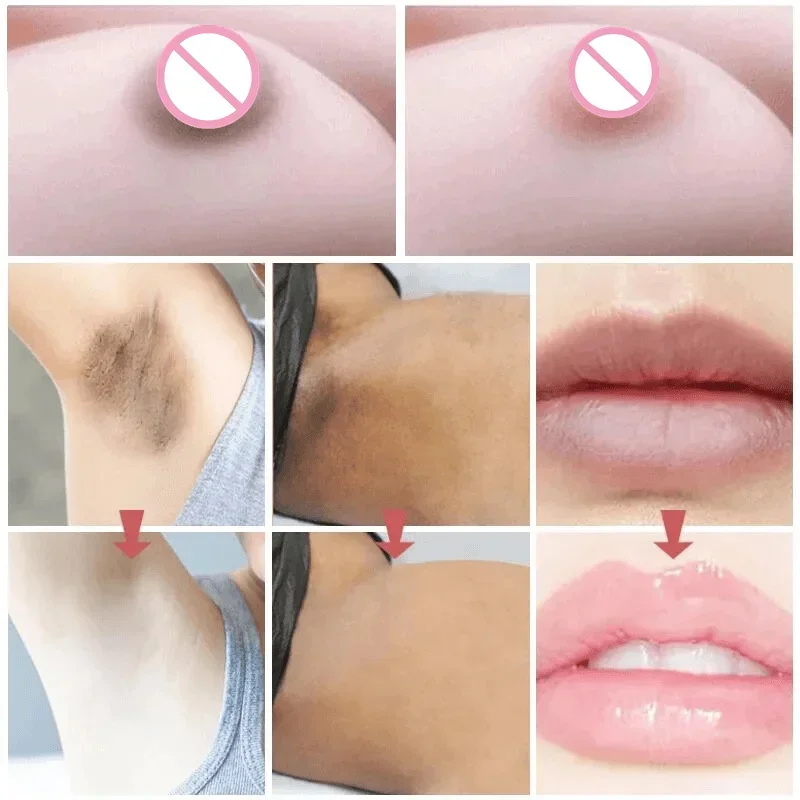 Clareamento essência para remover partes íntimas, partes do corpo, axila, pele, joelho, coxa, melanina interna