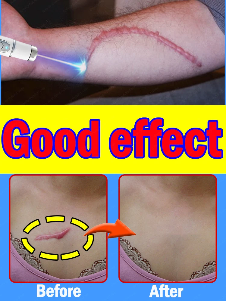 

Laser therapy Keloid scar