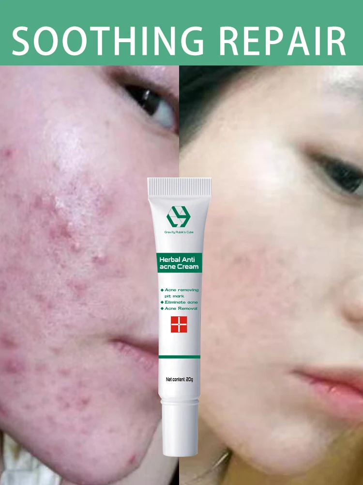 Herbal Acne Removal Cream Whitening Moisturizing Shrink Pores Oil Control Pimples Acne Treatment Gel Skin Care Face Cream