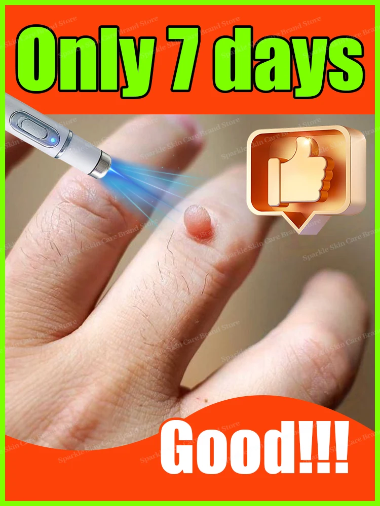 

Generation-2 Laser Says Goodbye To Warts In 7 Days