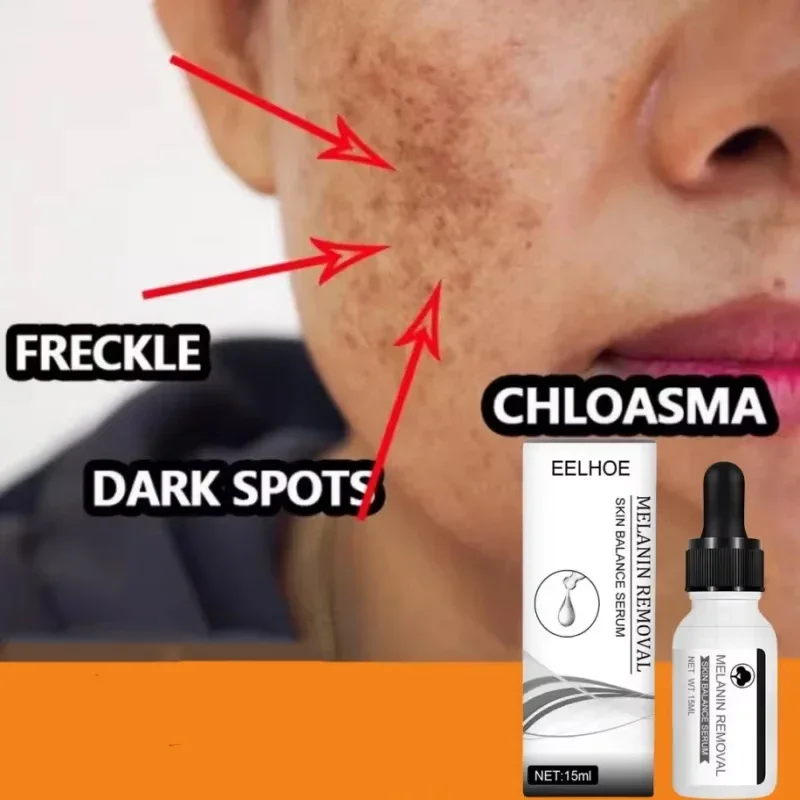 Niacinamide จุดด่างดํา Remover เซรั่ม Freckle Whitening Moisture Removal Black Dot ฝ้า Chloasma Face Skin Care ครีม