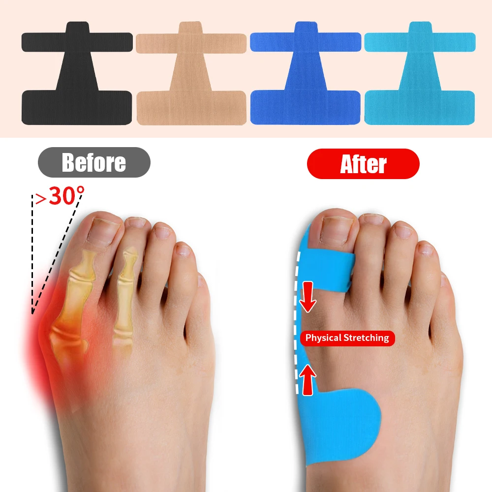 

Precut Kinesiology Tape for Bunion Corrector Big Toe Support Hallux Valgus Protective Tape Toe Corrector Straightener 10PCS/SET