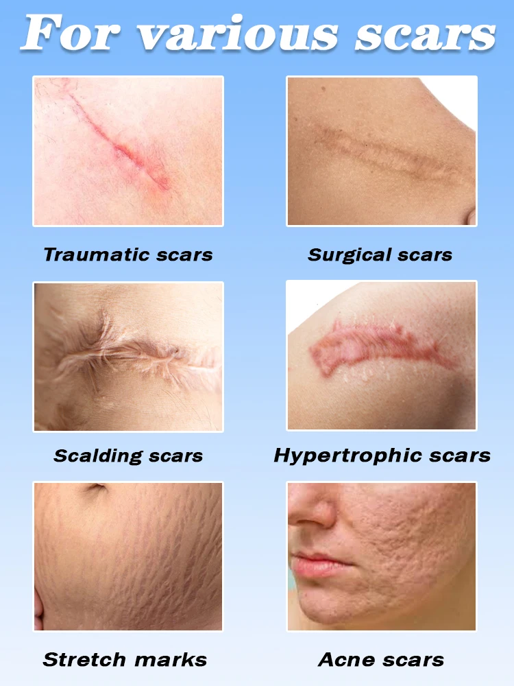 Magisch hellt Narben auf. Der professionelle Narbenlaserstift hilft Ihnen, dass die perfekte Haut immer noch sicher und effizient und schmerzlos ist