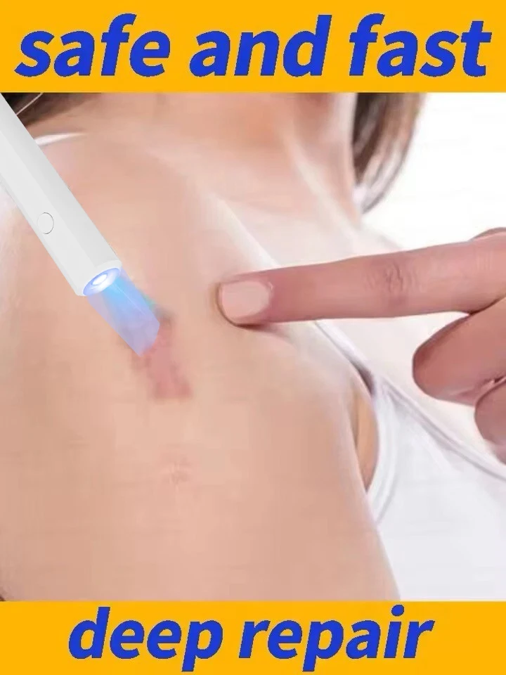 

The new generation blue light laser pen eliminates scars and gives you smooth and flawless skin