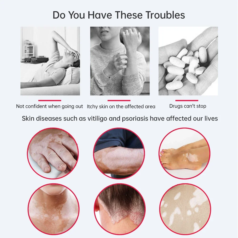 고품질 휴대용 UVB 램프 311nm UV 광선치료 필수 물리치료 장비 효과적인 치료용