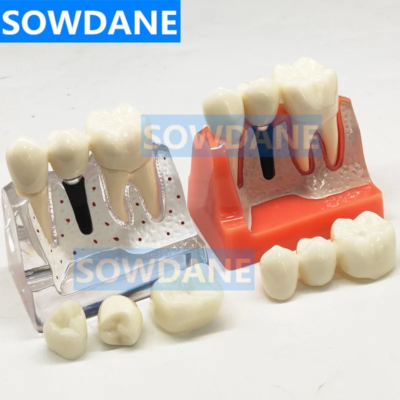 

4 Times Dental Implant Disease Analysis with Restoration Crown Bridge Demonstration Dental Teeth Teaching study Model