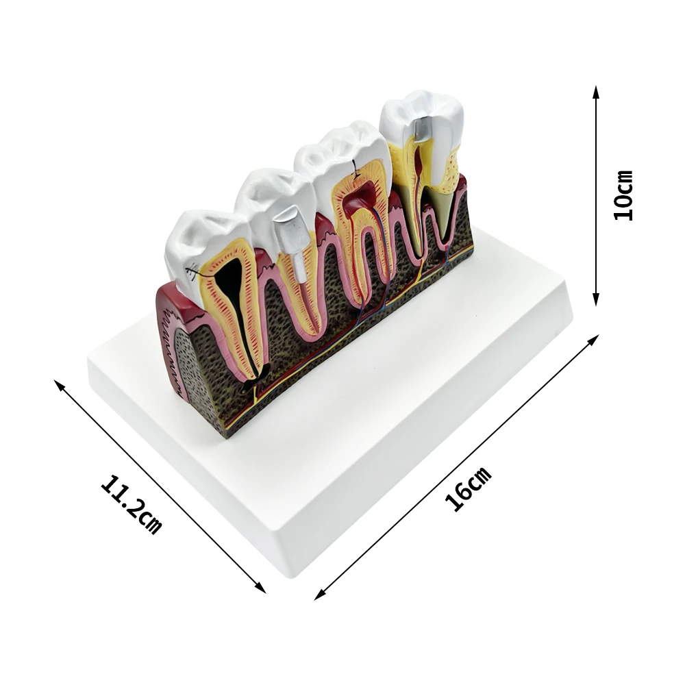 Próchnica zębów Model anatomiczny anatomiczne nauczanie stomatologiczne studiujące stomatologię Model demonstracyjny komunikacji kanałowej
