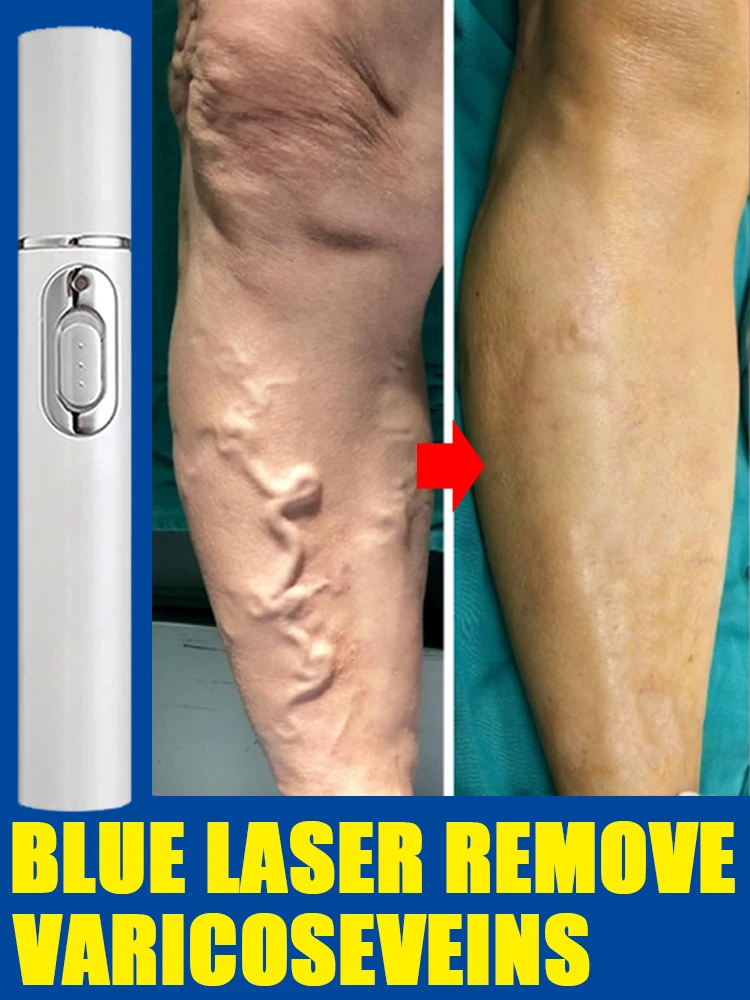 

Laser Therapy Leg Repair Pen Reduce Imcomfortable For Legs Improving Blood Circulation Skin Care Product