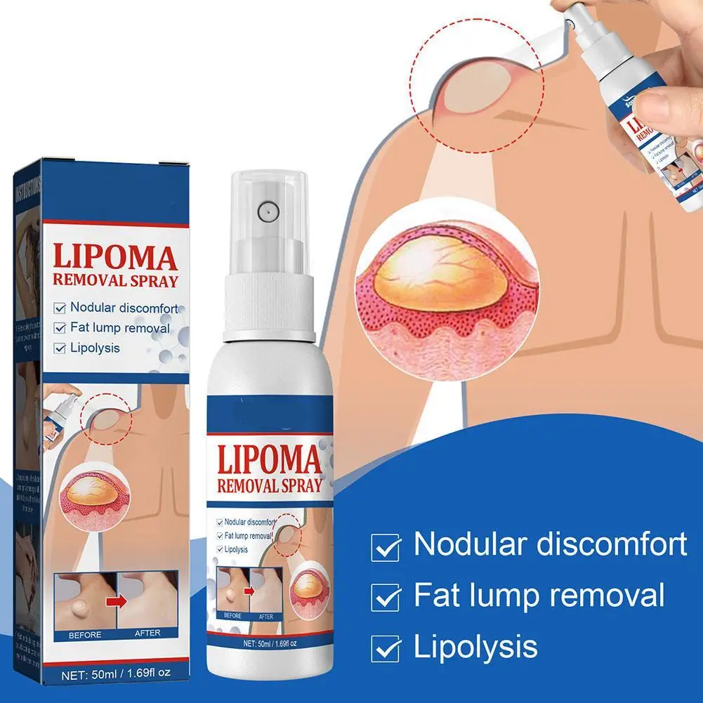 50ml Lipoma Removal Spray Anti tumorale gonfiore della pelle dolore lipolisi trattamento anticellulite Fibroma crema per alleviare i grumi di grasso corporeo