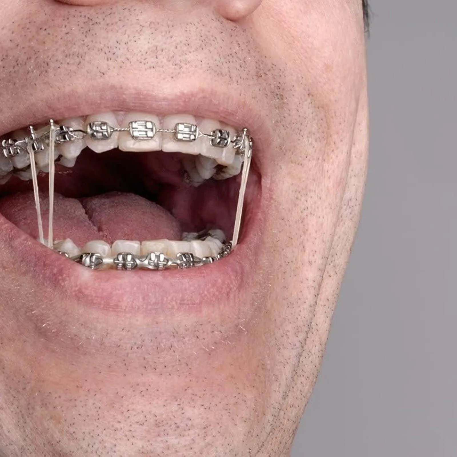 100 Pcs Rubber Bands For Teeth Care Teeth Elastics Braces Teeth Correcting Deformity 3.5 Oz 3/8