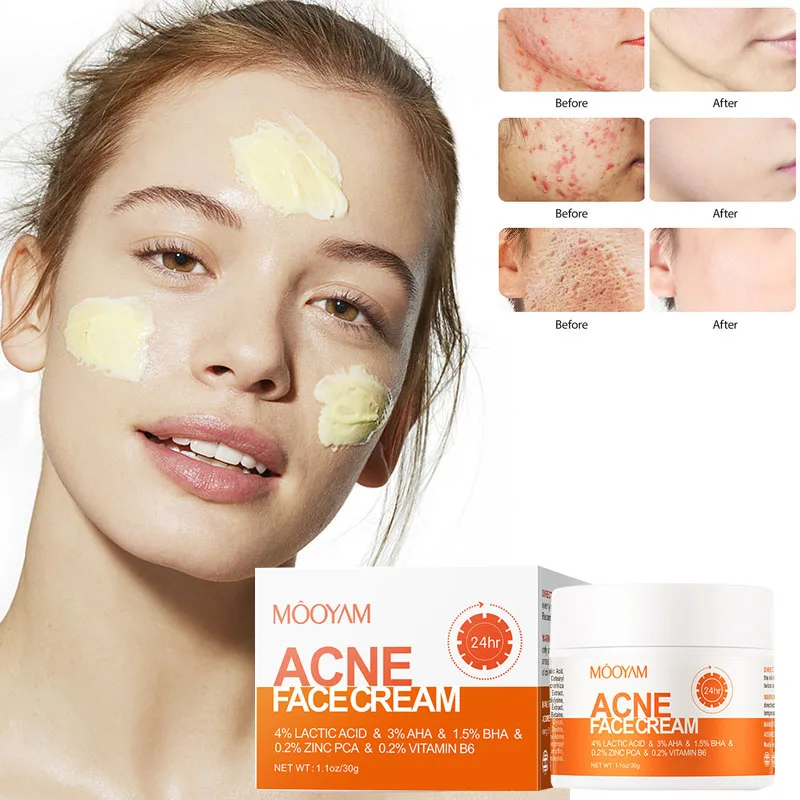 

Salicylic acid repair acne cream dilute acne marks remove closure improve acne pits firm skin soothes skin Skincare
