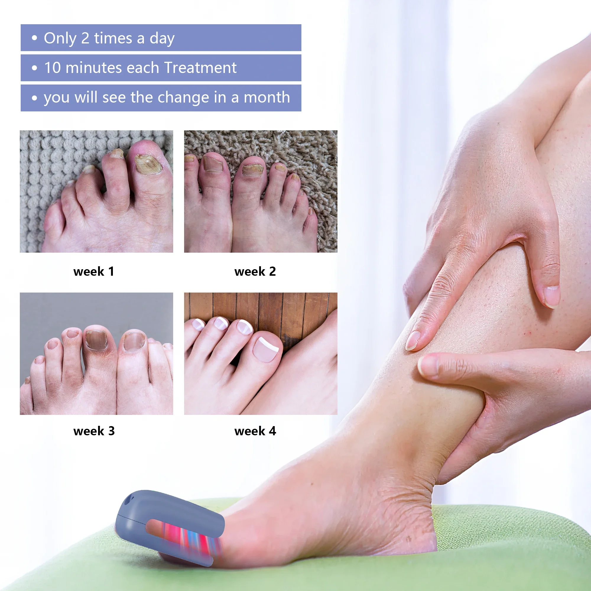 Nail fungus laser therapy device, USB charging, onychomycosis treatment, treatment machine, neutral foot care tool