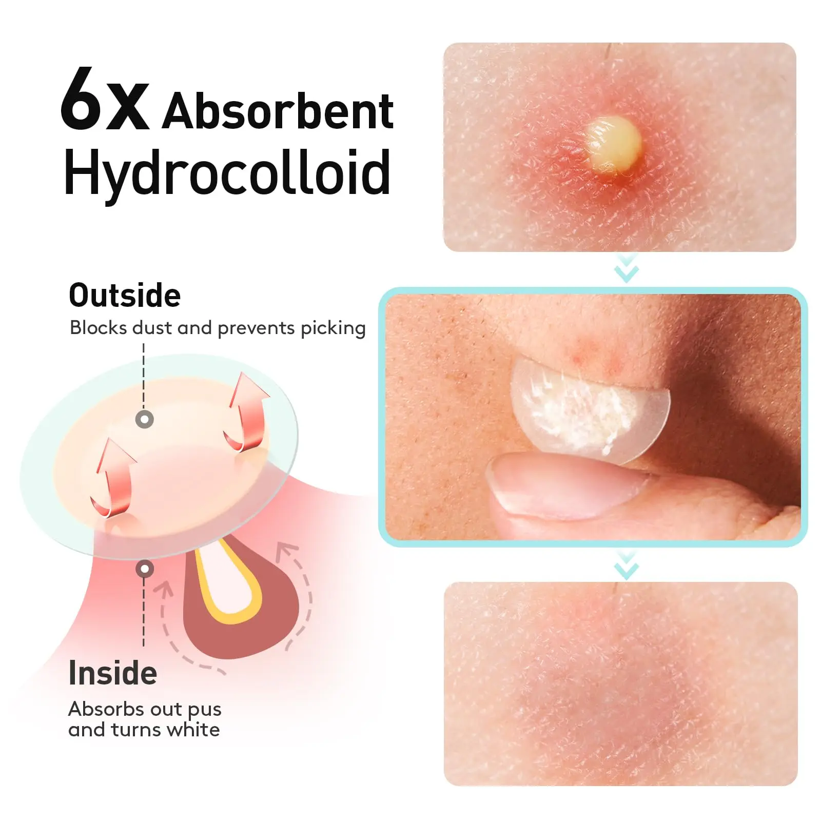 Acne Patches, Invisible and Traceless Concealer, 360 Pieces | Face Cleansing/Absorbing Acne Thin, Invisible, Waterproof and Brea