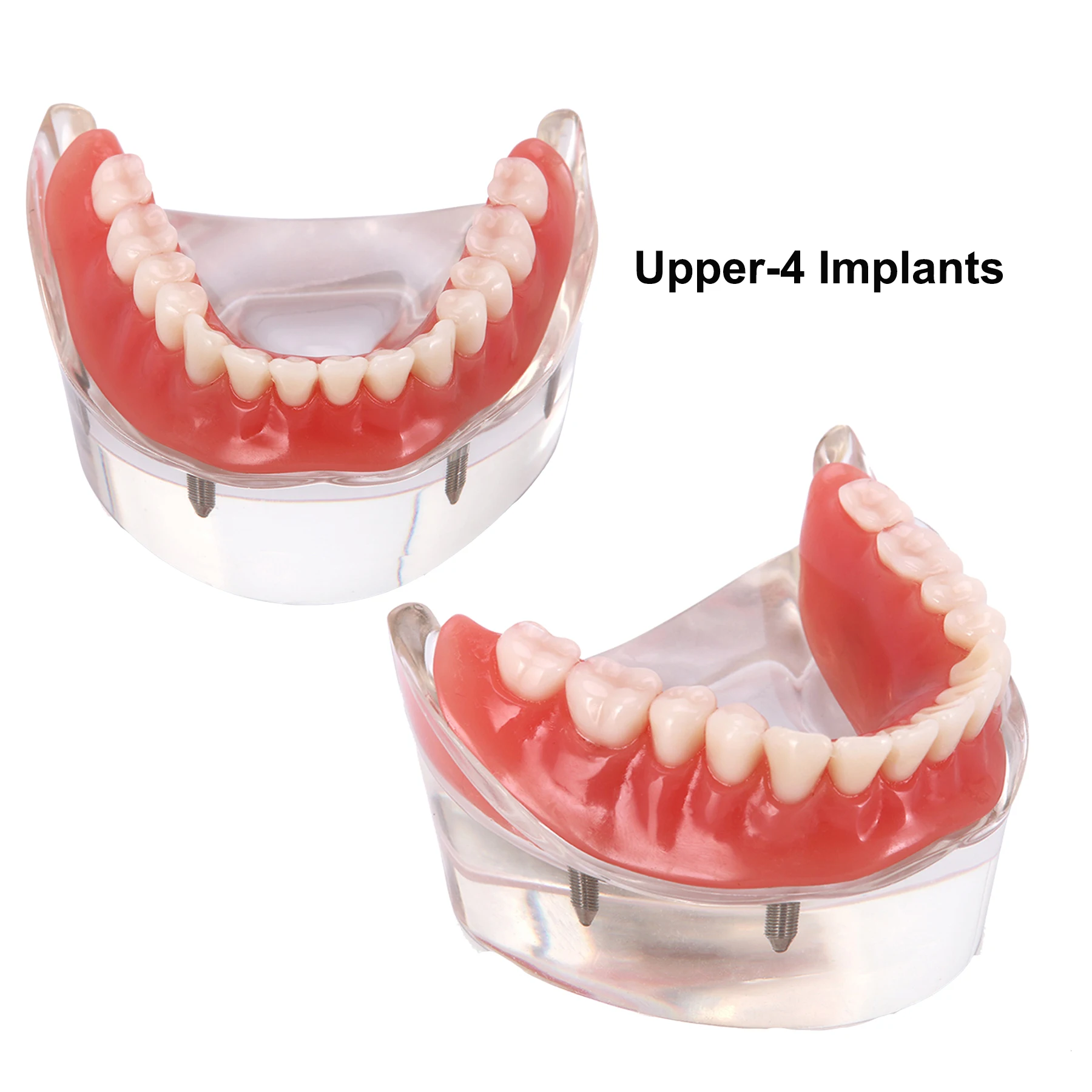 Dental Teeth Model 4 Upper Implants Overdenture Restoration Model For Dentist Patient Demo Explain Implants Functioning